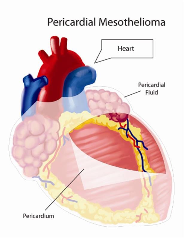 Pericardial Mesothelioma graphic