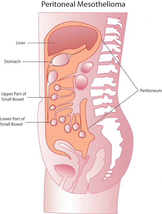 Peritoneal Mesothelioma graphic