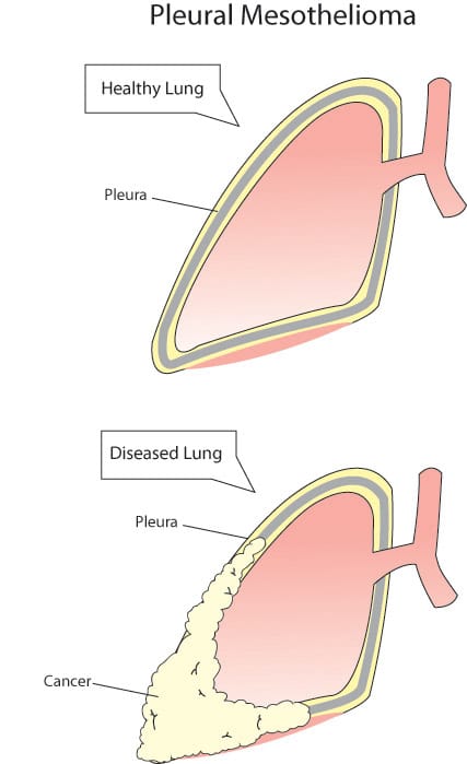 Pleural Mesothelioma