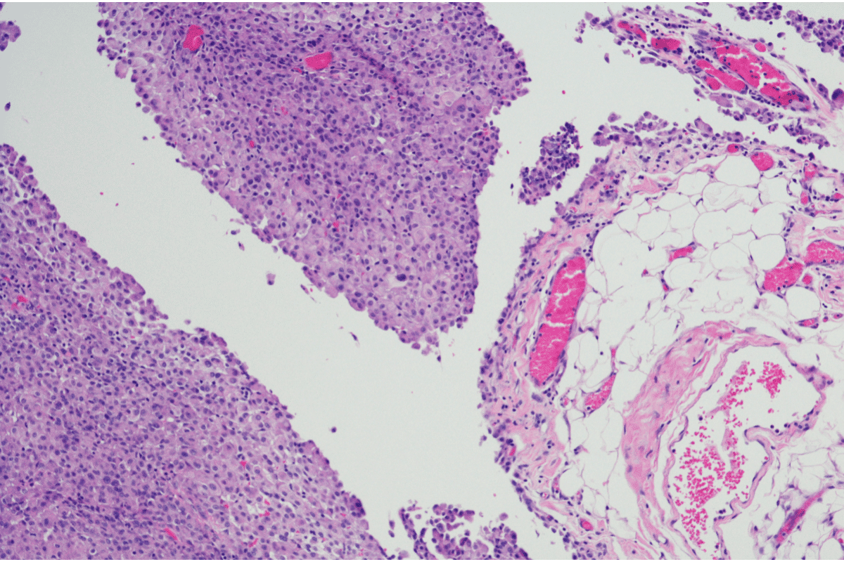 micrograph of peritoneal mesothelioma