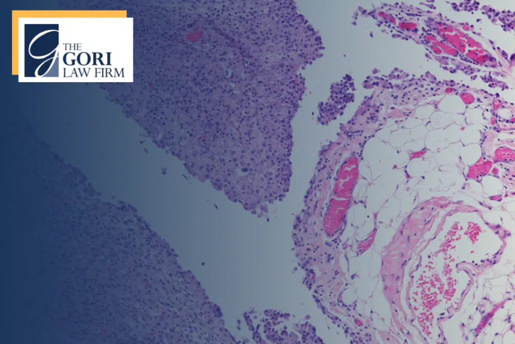 Trusted Peritoneal Mesothelioma Lawsuit Attorneys